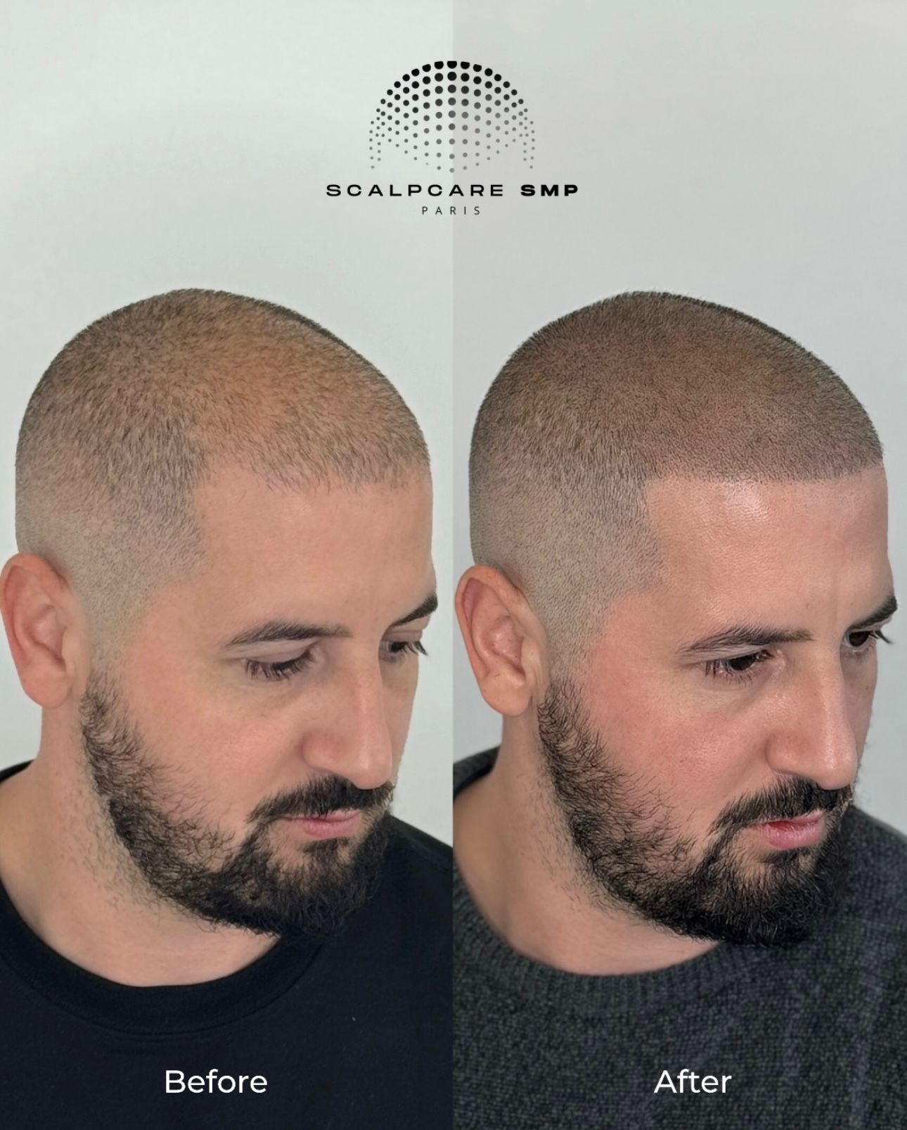 Résultat avant après de micropigmentation capillaire 6