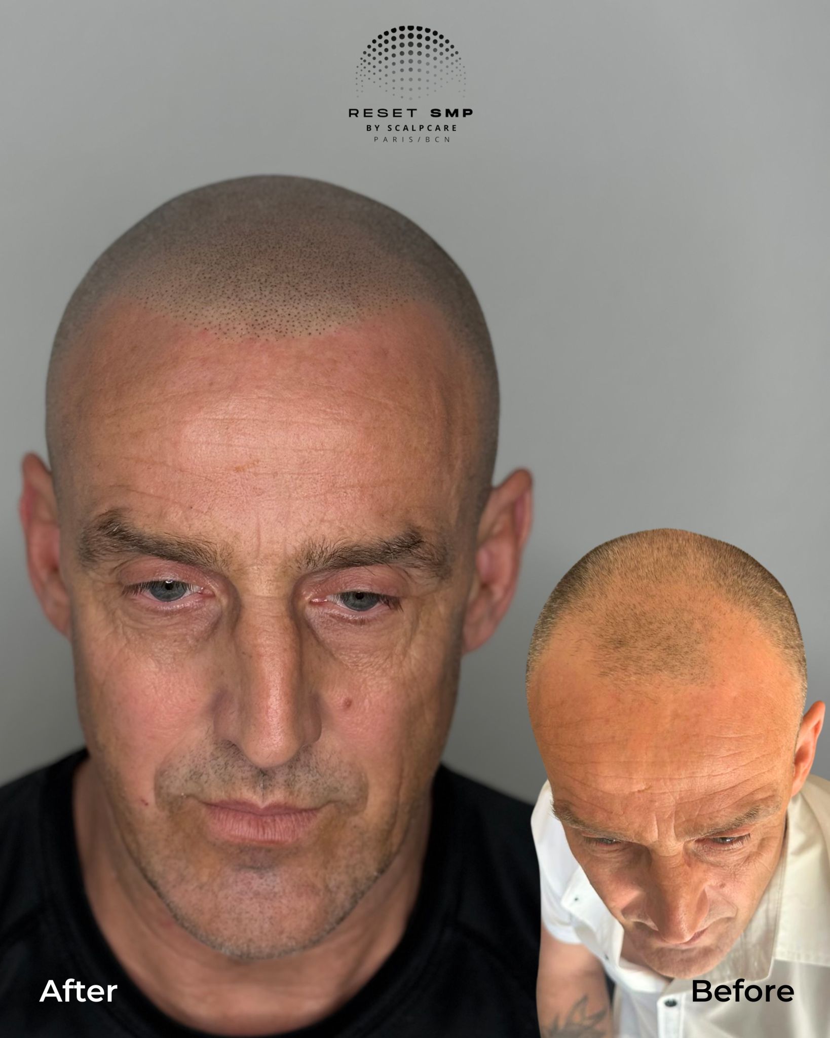 Résultat avant après micropigmentation capillaire Reset SMP