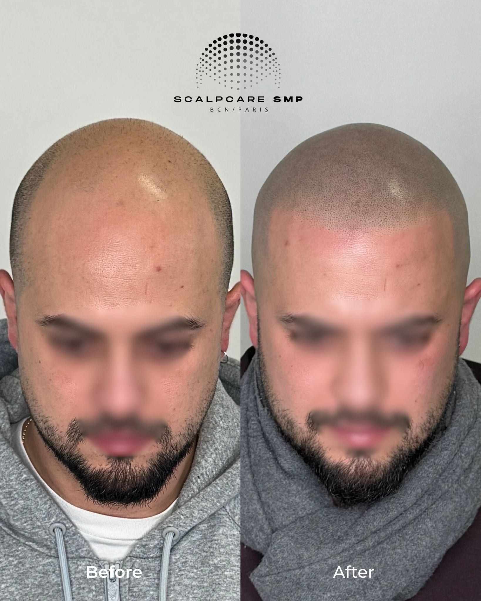 Résultat avant après micropigmentation capillaire Reset SMP