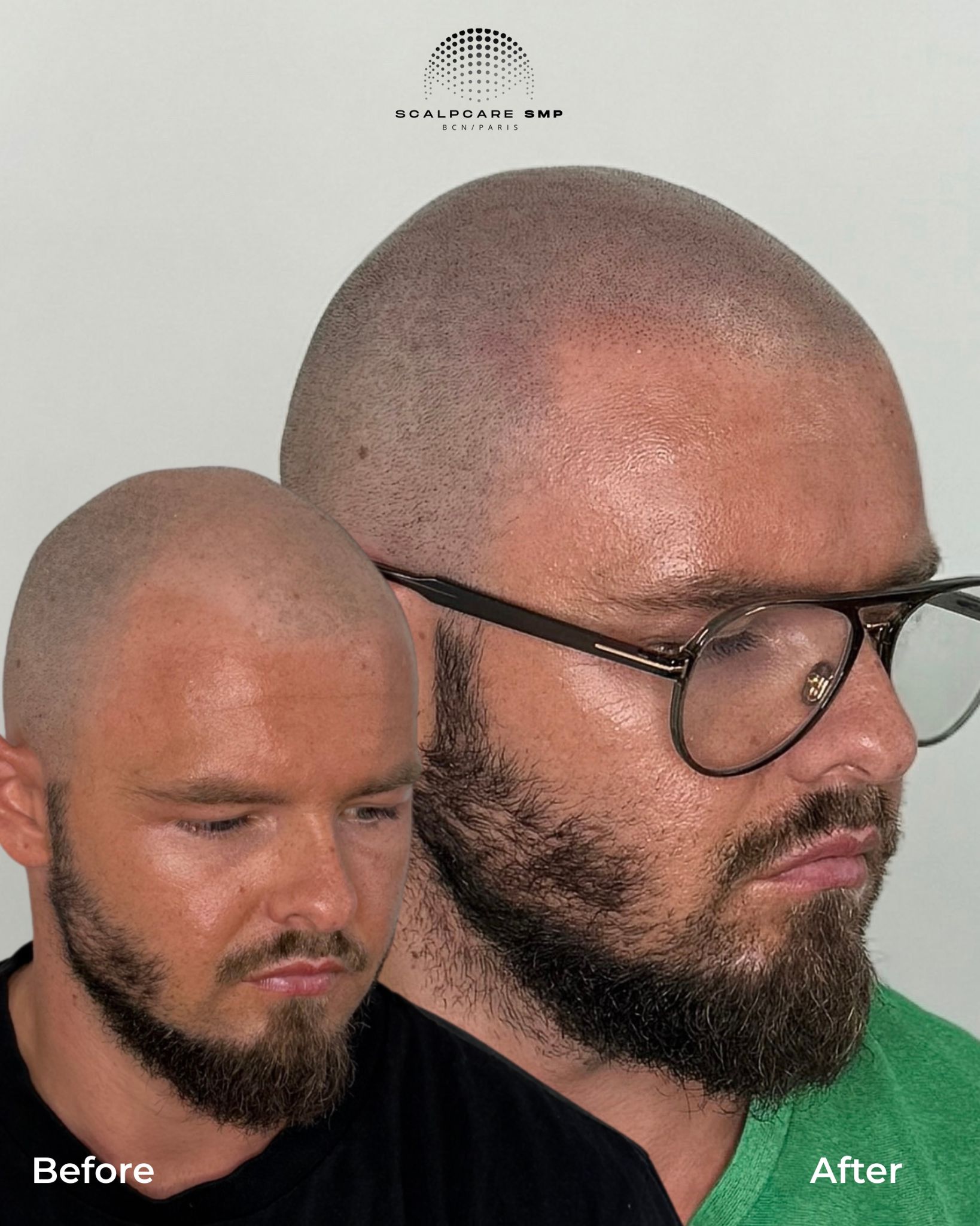 Résultat avant après micropigmentation capillaire Reset SMP
